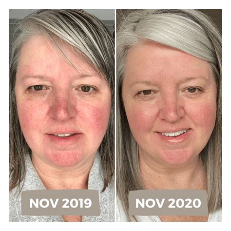 My Experience With Laser Treatment For Rosacea Including Before And After Photos Dimplesonmywhat