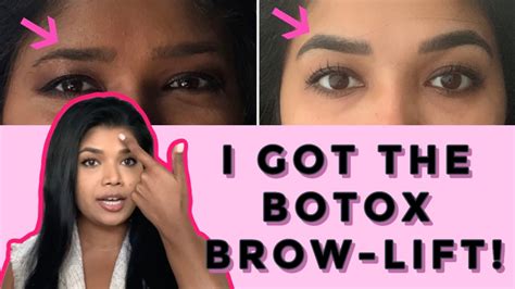 Botox Brow Lift My Results And How Much I Paid Youtube