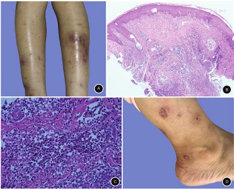 Mycobacterium Chelonaeabscessus Co Infection Of The Limbs A