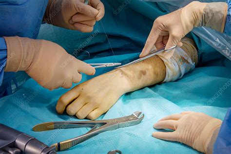 Orthopedic Surgery Stock Image C Science Photo Library