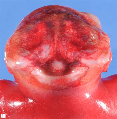 anencephaly - Humpath.com - Human pathology