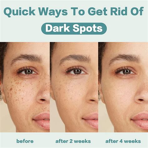 CITYGOO Dark Spot Remover Cream for Face & Body - Natural Skin Care for