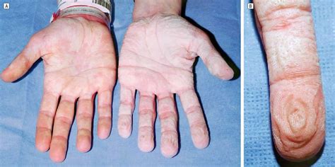 Aquagenic Syringeal Palmar Keratoderma Causes Symptoms Diagnosis