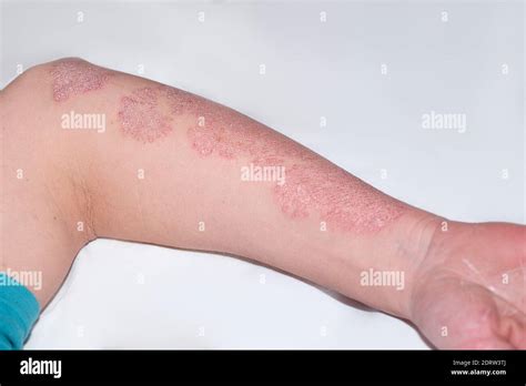 Psoriasis Hand Hi Res Stock Photography And Images Alamy