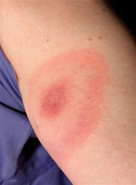 They are about a ½ inch to 1 inch long. The Three Stages of Lyme disease