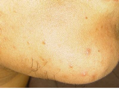 Heredity, which naturally brings excess hairs depending on your race, nationality and family. Unwanted Facial Hair (Hirsutism)