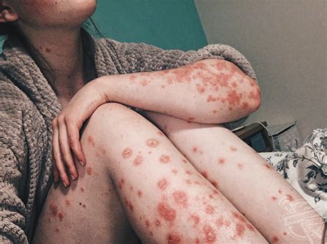 This Girl Is Showing Her True Spots As She Embraces Her Skin Condition