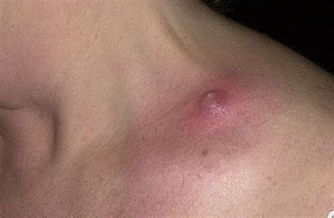 Boil On Neck Pictures 2 Photos And Images