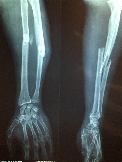 Fractura Doble De Antebrazo