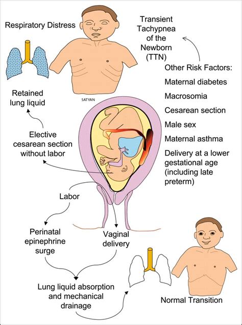 There can be many causes of respiratory distress in children. Newborn Respiratory Distress including TTN | Newborn ...