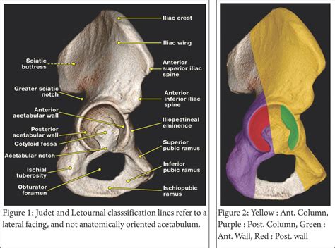 Understanding Clinical Radiology Of Fracture Acetabulum Trauma