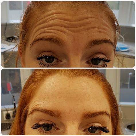 Facial Rejuvenation Anti Wrinkle Botox Leeds
