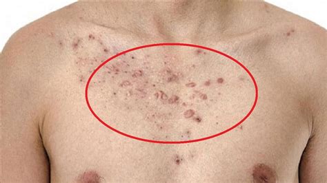 How To Get Rid Of Chest Acne Naturally Youtube