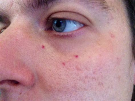 Small Red Spots On Face