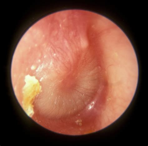 Acute Otitis Media —