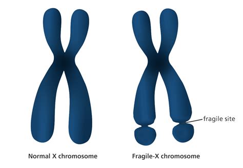 Epigenetics May Provide Relief For Fragile X Syndrome And Intellectual