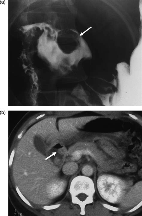 Benign Submucosal Lesions Of The Stomach And Duodenum Imaging Characteristics With Endoscopic