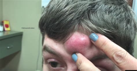 Giant Cyst On The Forehead