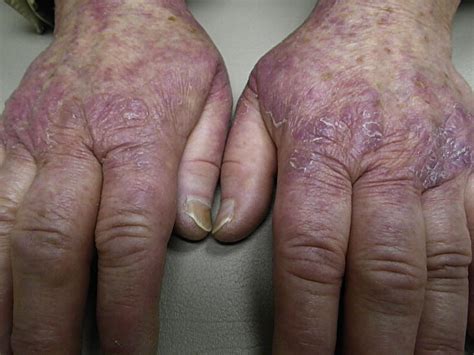 Chemotherapy Induced Acral Erythema Sparing The Palms Journal Of The