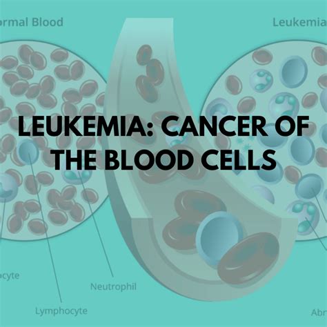 Leukemia Cancer Of The Blood Cells Niruja Healthtech