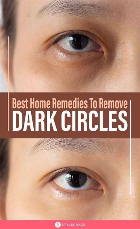 13 Natural Ways To Treat Dark Circles Under The Eyes At Home Dark