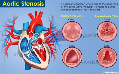 Aortic Stenosis Causes Symptoms Treatment Prognosis Pathophysiology
