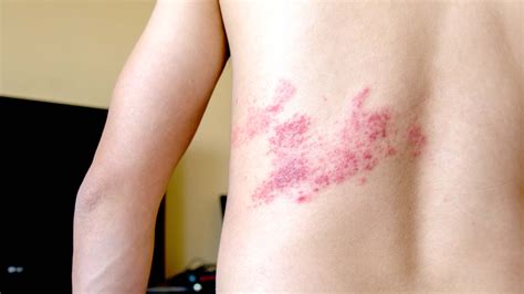 what is shingles causes treatment and vaccine info goodrx