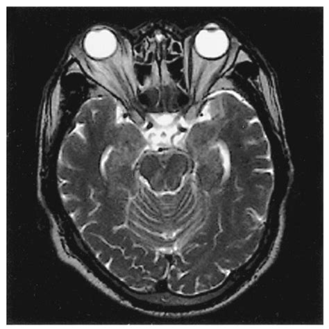 T2 Weighted Image Of Orbital Mri Shows Mild Periorbital Swelling And