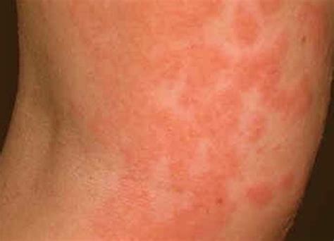 Contact Dermatitis Pictures Symptoms Causes Treatment Hubpages
