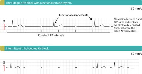 An overview of the atrioventricular block (heart block), including typical ecg findings, aetiology, clinical features and management. Third-degree AV block (3rd degree AV block, AV block 3, AV ...