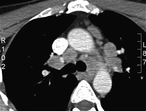 Right Vocal Cord Paralysis And Mediastinal Lymphadenopathy Thorax