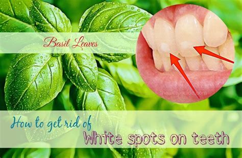 34 Tips How To Get Rid Of White Spots On Teeth Fast And Naturally