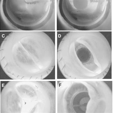 A Construction Of The Bicuspid Aortic Valve Bav Model From A Porcine