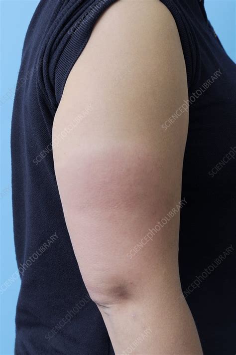Insect Bite On The Arm Stock Image C0095333 Science Photo Library