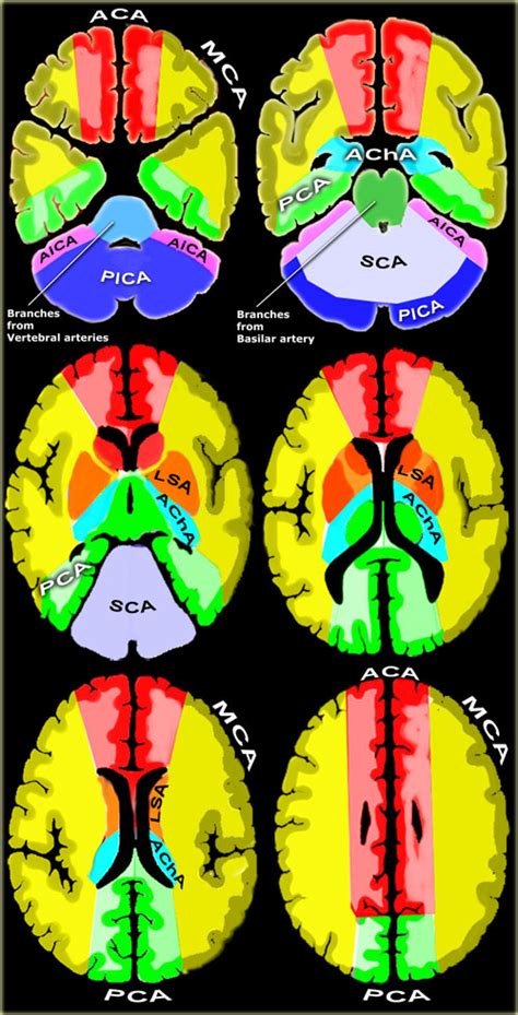 The Radiology Assistant Vascular Territories Of The Brain