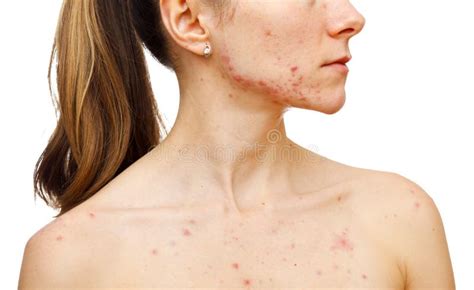 Skin Problems Stock Image Image Of Dermatology Infection 28587565