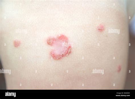 Impétigo Infección Dermatológica Bacteriana Contagiosa En La Piel De Un