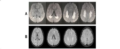 White Spots In Brain Mri
