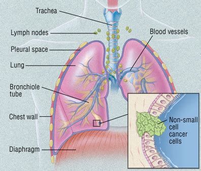 Both types of lung cancer primarily affect cats that are over ten years of age. Fundraising For Adenocarcinoma Cancer - Crowdfunding Experts