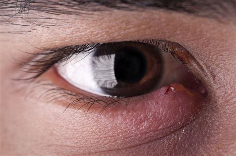 Swollen Eyelid Common Causes