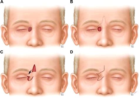 Glabellar Flaps In Nasal Reconstruction Plastic Surgery Key