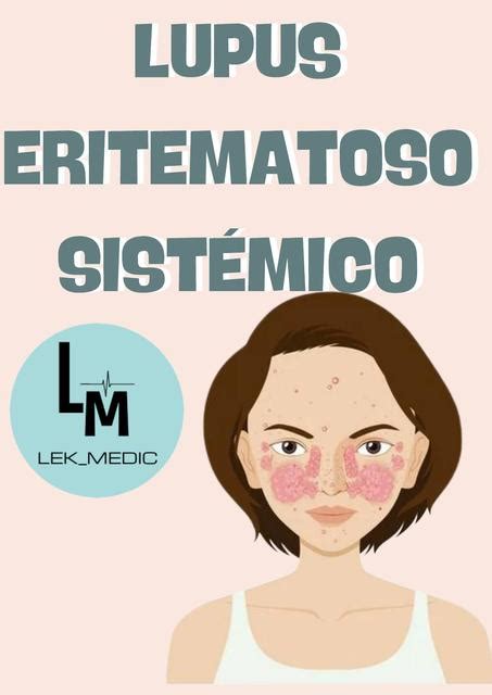 Lupus Eritematoso Sistémico Lekmedic Udocz