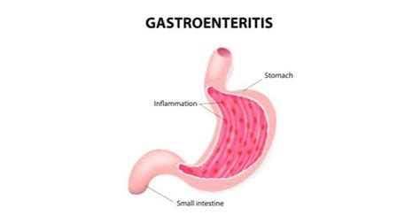 Clinical features of viral and bacterial gastroenteritis in hospitalized. Gastroenteritis Causes, Symptoms and Treatment - Mediologiest