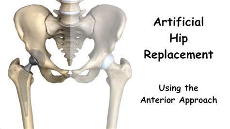 Benefits Of Hip Replacement Using The Direct Anterior Approach