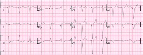 Dr Smiths Ecg Blog Paced Rhythm Is There Ischemic St Elevation