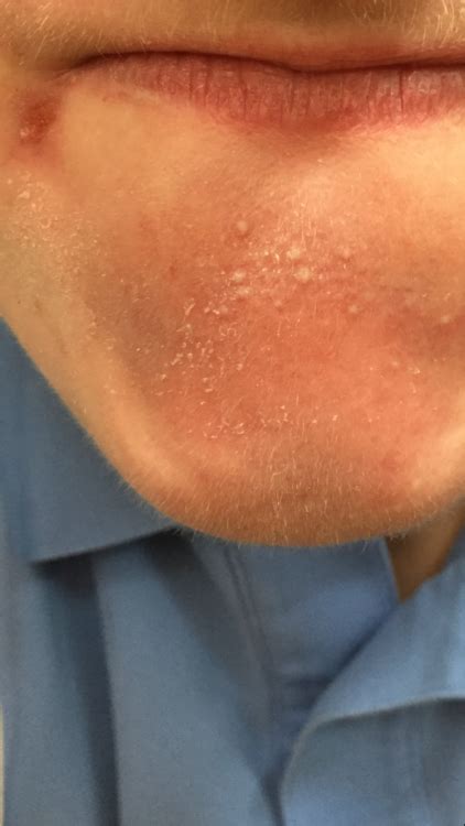 Little White Bumps That Turn Into Pimples General Acne Discussion