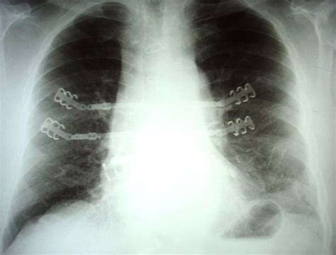 Postoperative Chest X Ray Showing The Implants On The Day Of Discharge