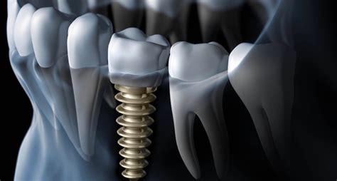 Causes Of Dental Implant Failure What You Need To Know