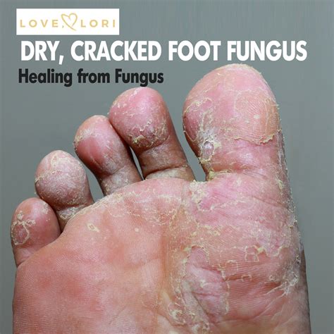 Dry Cracked Feet Fungus Toenail Fungus And Athletes Foot Cures