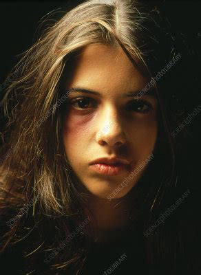 Teenage Girl With A Black Eye And Facial Bruising Stock Image M Science Photo Library